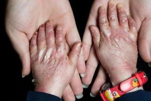 دستان یک کودک مبتلا به بیماری پروانهای